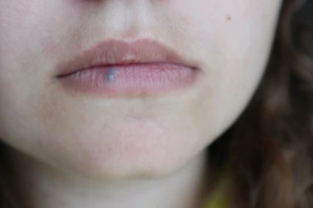 मौत से लगता है डर तो Lip Cancer से रहें सावधान, इस चीज को पीने से होगा….