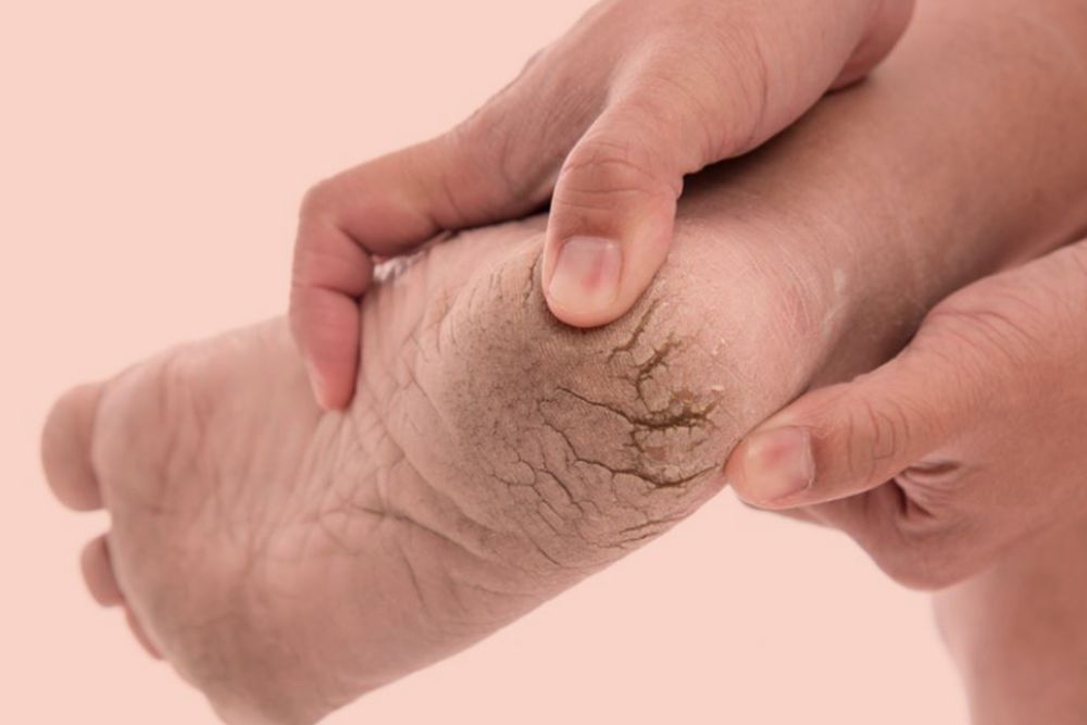 Cracked Heels: सर्दियों में फटी एड़ियों से हैं परेशान, तो आजमाएं ये असरदार घरेलू नुस्खे