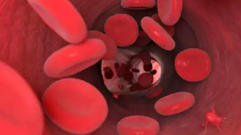 आयुर्वेद के 3 उपाय दूर करेंगे एनीमिया की परेशानी