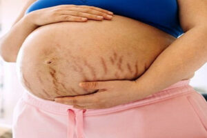 गर्भावस्था में स्ट्रेच मार्क्स? आयुर्वेद से जानिए बचाव के उपाय